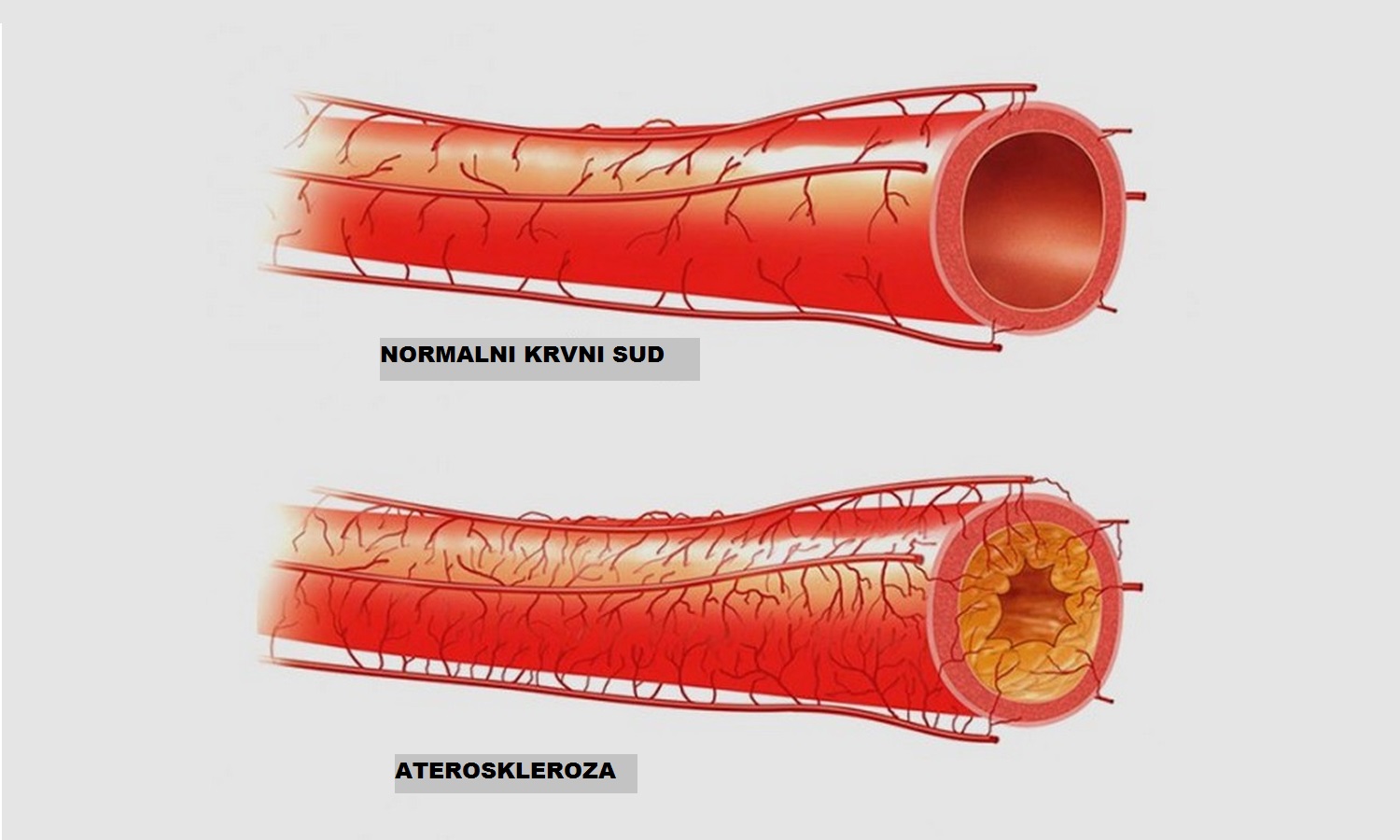 Почему сделать сосуды. Атеросклеротическое поражение кровеносных сосудов. Атеросклероз коронарных артерий симптомы. Атеросклероз сосудов бца. Атеросклеротическое поражение сердечных артерий.
